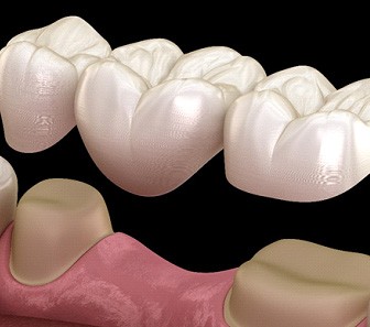 example of a traditional dental bridge in McKinney 