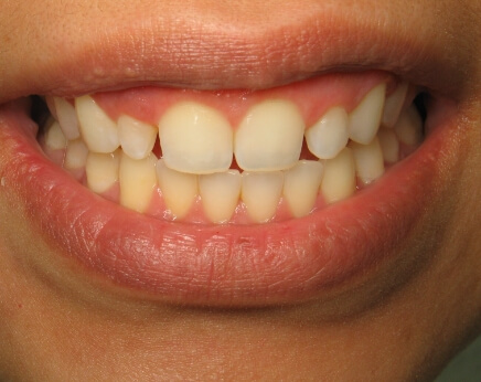 Small unevenly spaced teeth before cosmetic dentistry