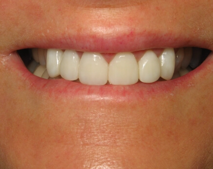 Smile before dental care