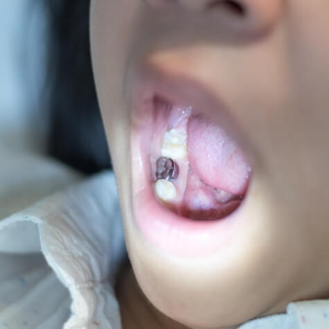 Dentist examining patient's smile after placing dental sealants