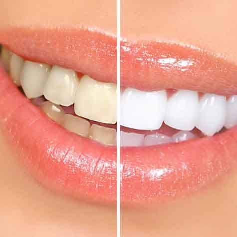 Before and after teeth whitening?